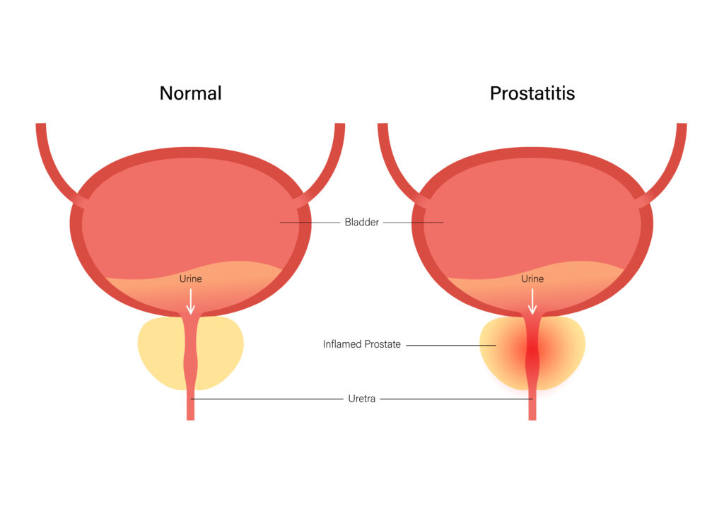 Prostate Disease